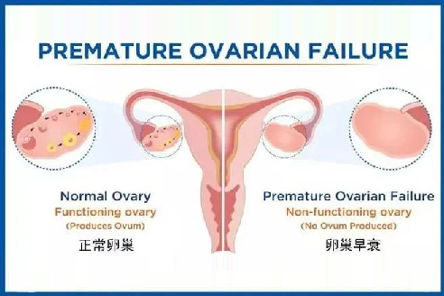 干细胞治疗卵巢早衰：为 “生命之巢” 注入新活力